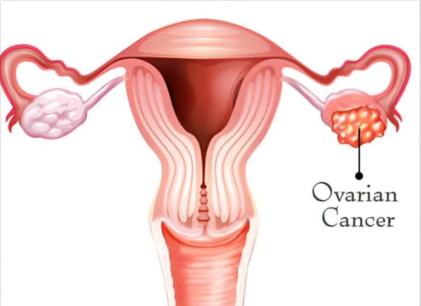 kanser ovari